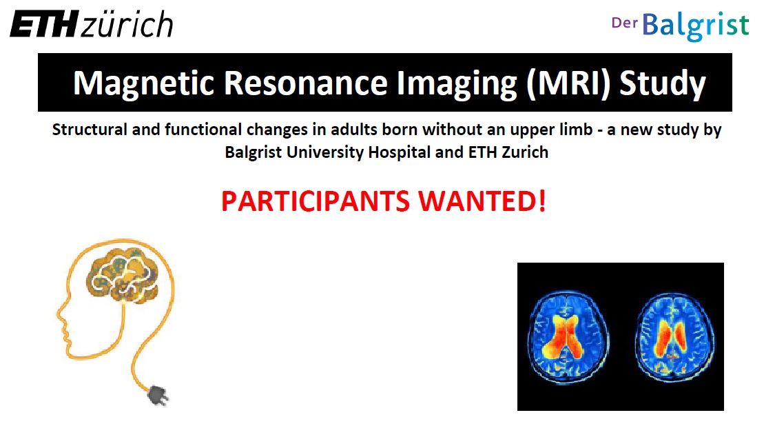 Gezocht voor onderzoek: mensen met dysmelie aan een van de armen